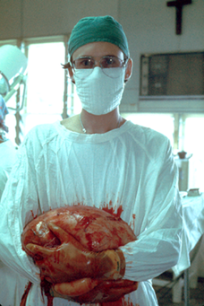 Dr Ross Pennie holding 9L ovarian cyst he removed from a patient in Papua New Guinea